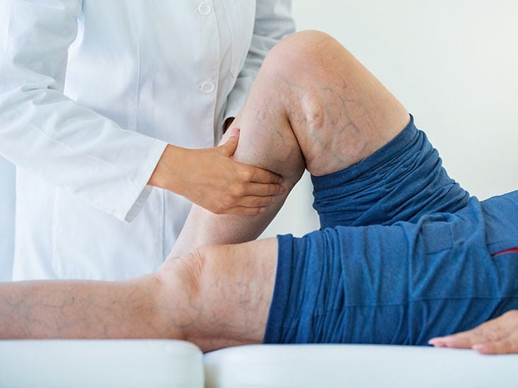 Deep Vein Thrombosis: Symptoms, Risks and Prevention Management