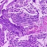 Stanford Researchers Develop uRARE-seq Urine Test for Bladder Cancer