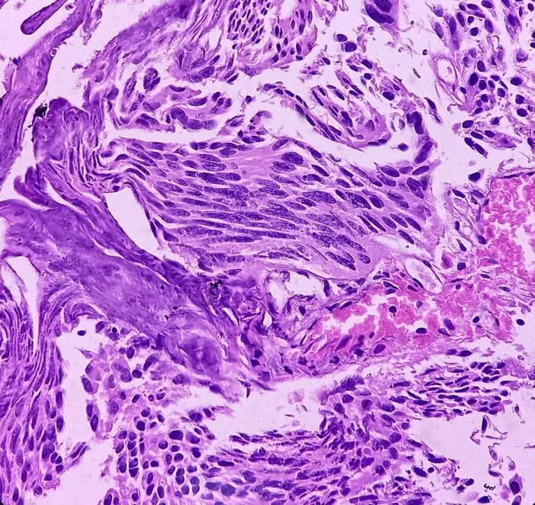 Stanford Researchers Develop uRARE-seq Urine Test for Bladder Cancer